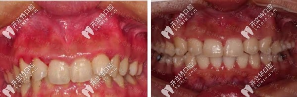 金屬自鎖矯正器糾正深覆合