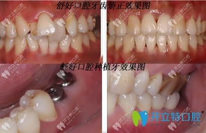 威海舒好口腔種植牙和牙齒正畸案例效果圖