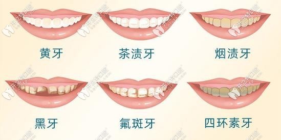 哪些牙齒可在沈陽百嘉麗做冷光美白
