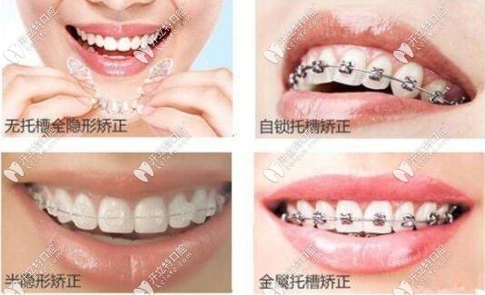 三明瑞爾口腔牙齒矯正價(jià)格