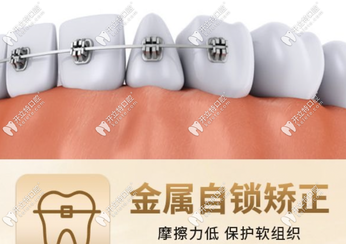 長沙星沙美奧口腔整牙價格表