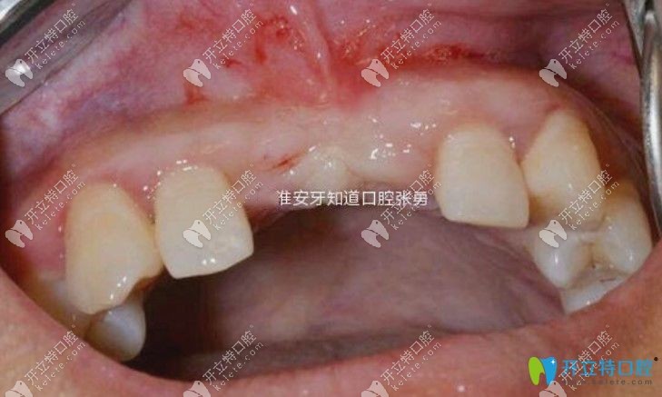 門牙因為意外折斷怎么辦