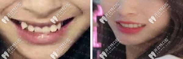 陶瓷半隱形矯正牙齒擁擠