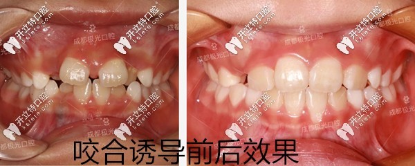 儿童咬合诱导的意义及案例效果图