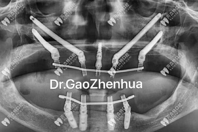 穿顴穿翼種植手術(shù)