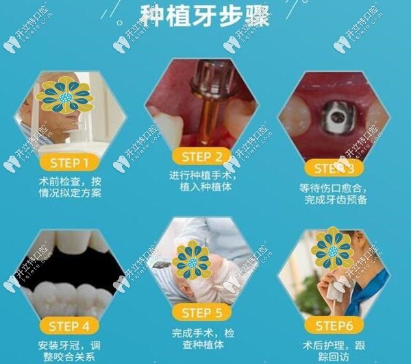 <!--<i data=20240703-sp></i>-->美口腔種植牙詳細(xì)步驟