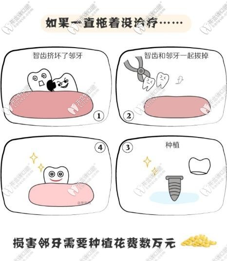 智齒不及時(shí)拔除的危害