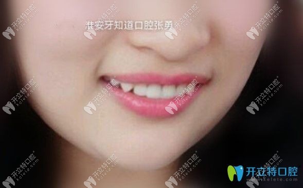 牙知道張勇做即刻種植牙修復(fù)缺失門牙案例