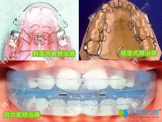 乳牙反頜3種矯正器