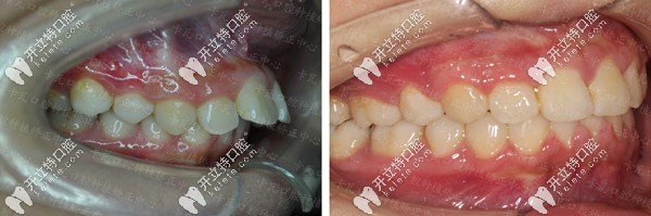 金屬托槽矯正齙牙