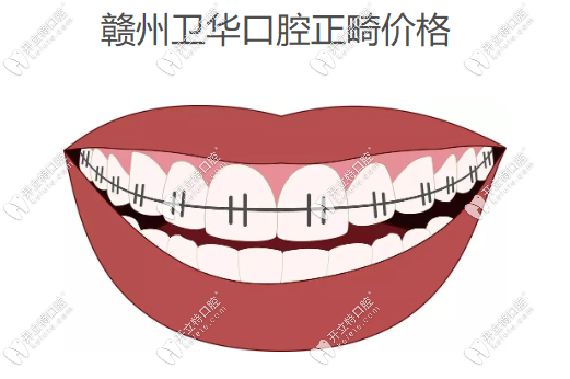贛州衛(wèi)華口腔正畸價(jià)格