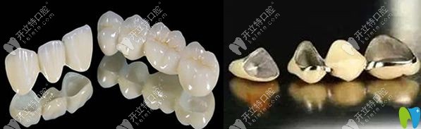 深圳博愛(ài)口腔全瓷牙和普通烤瓷牙的效果
