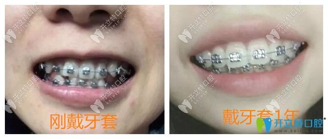 常州北极星口腔牙齿拥挤矫正1年效果