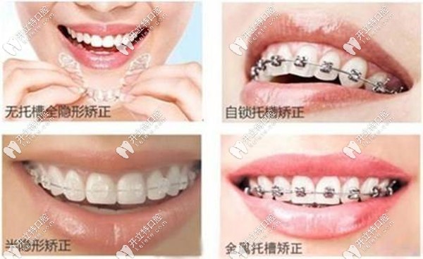 三明詩藝口腔牙齒矯正收費標(biāo)準(zhǔn)