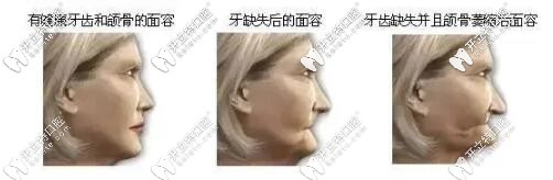 牙齿缺失加速面容衰老