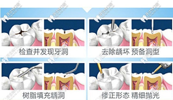 補(bǔ)牙過程圖解