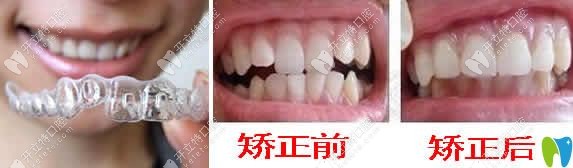 重慶華諾世口腔隱形牙齒矯正案例效果圖