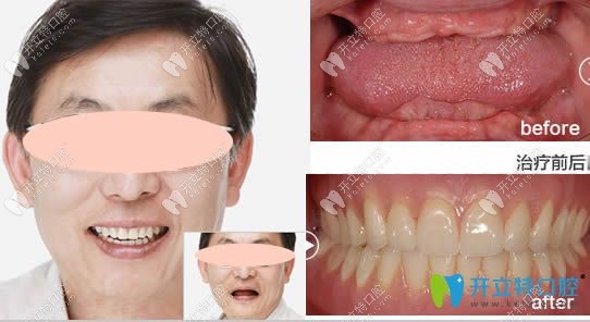 深圳格倫菲爾口腔全口種植牙前后效果對比圖