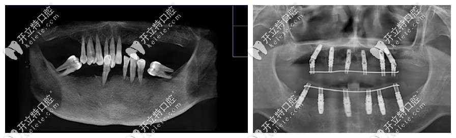 南京美奧口腔馬建民醫(yī)生的種牙病例