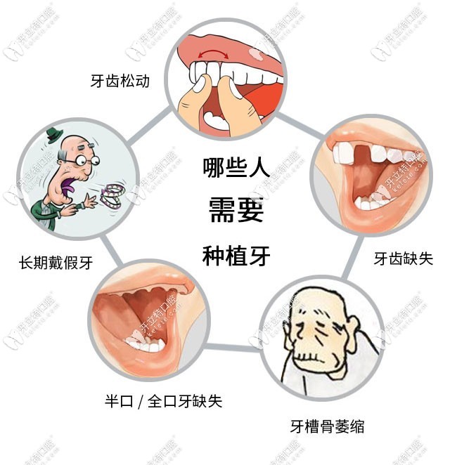 廈門麥芽口腔可參與種植牙集采的人群