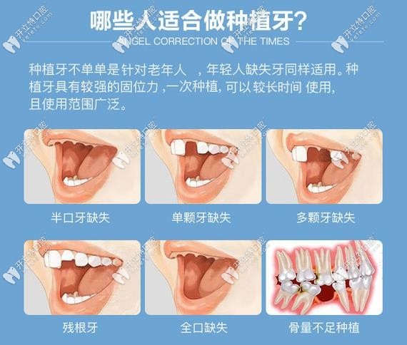 哪些人是比較適合在德陽新橋口腔做種植牙？