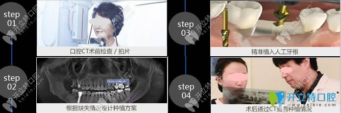 深圳格倫菲爾口腔種植牙流程圖