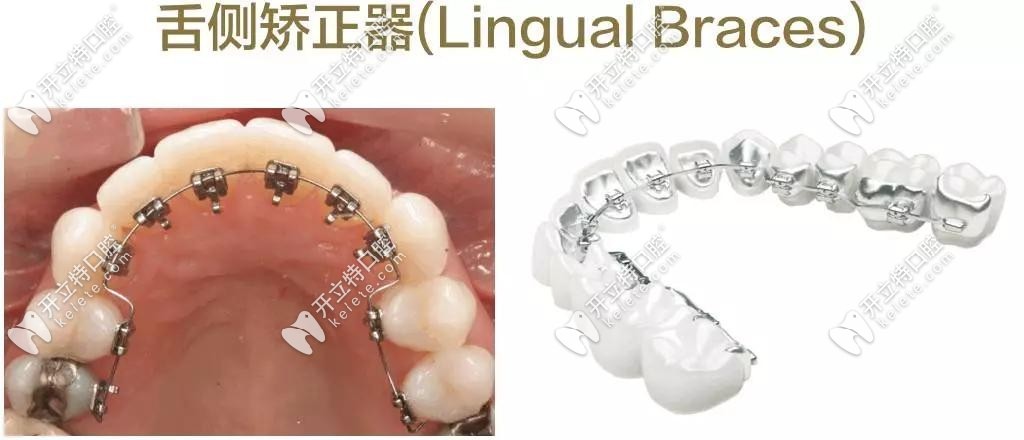 瑞泰牙科醫(yī)院舌側(cè)隱形矯正醫(yī)生