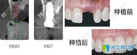 重慶華諾世口腔種植牙前后對(duì)比圖