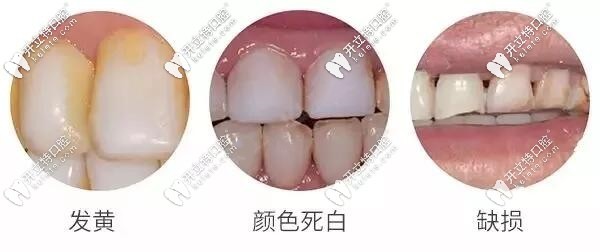 樹脂貼面幾年后圖片