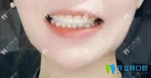 珠海九龍口腔醫(yī)院半隱形陶瓷矯正案例