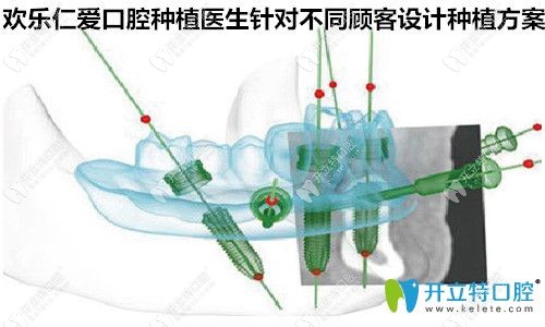 欢乐仁爱口腔种植医生设计方案