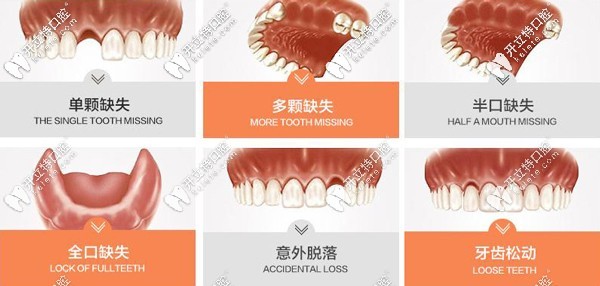 牙齒什么情況下需要做種植牙