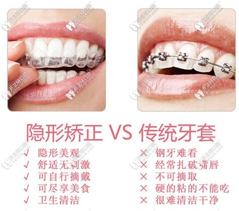 隐形矫正和传统矫正区别图示