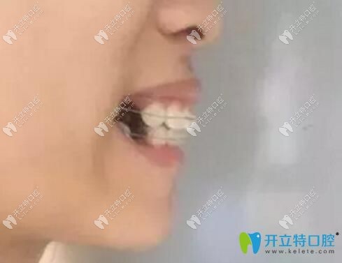 珠海牙齒矯正價格看我花1萬多值不值