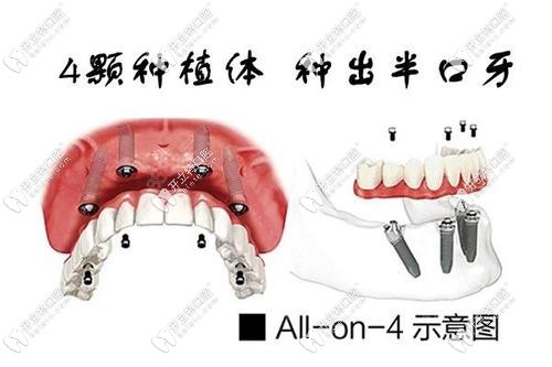 all-on-4種植牙示意圖