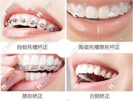 牙套的類型