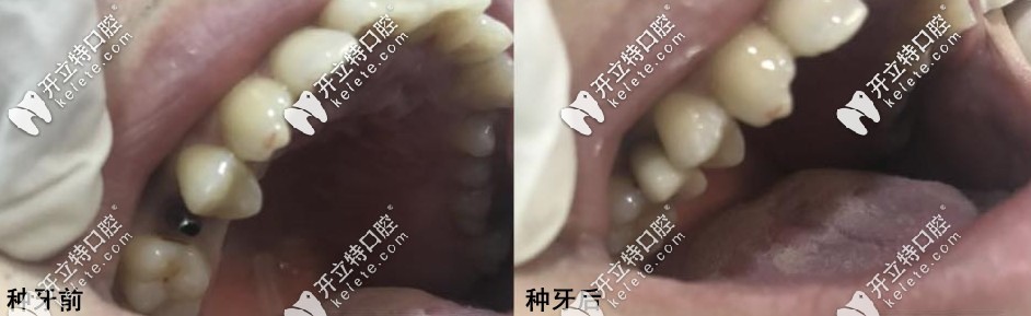種牙前后對比