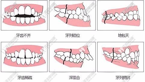 哪些牙齿需要矫正