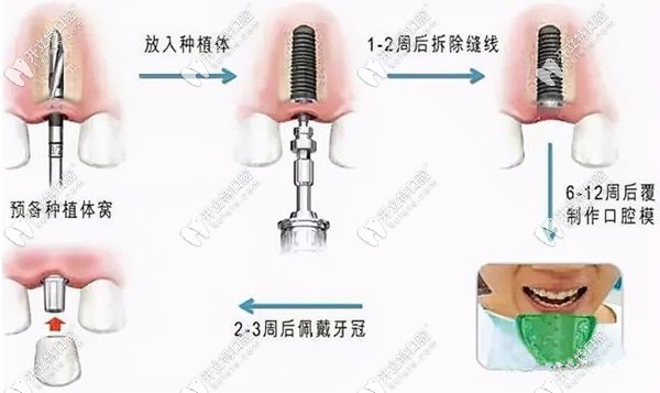 種植牙手術(shù)過程示意圖