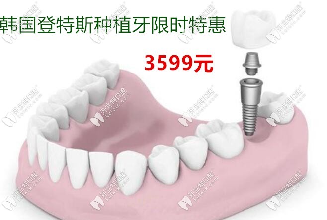 邯鄲韓國登特斯種植牙限時特惠3599一顆