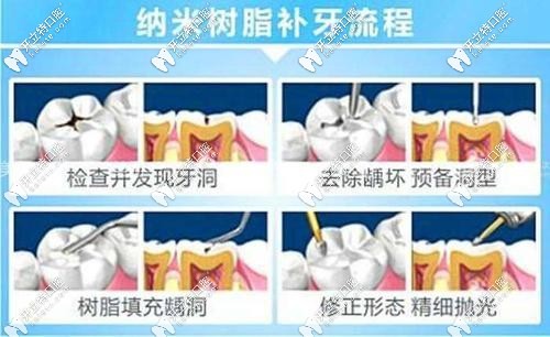 树脂补牙过程