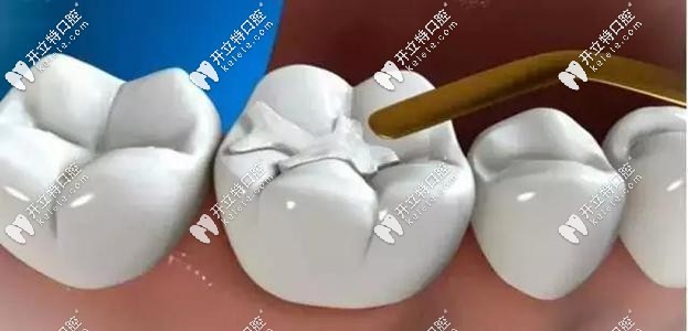 补牙示意图