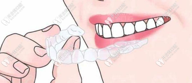 美立刻隐形牙套可以治龅牙嘛