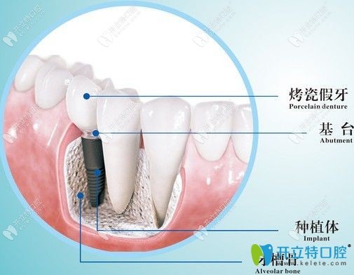 種植牙結(jié)構(gòu)圖介紹