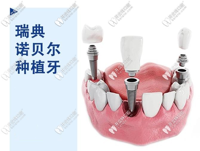 诺贝尔PMC种植体价格