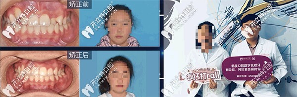 昆明尚愛韓美做隱適美矯正<span style=
