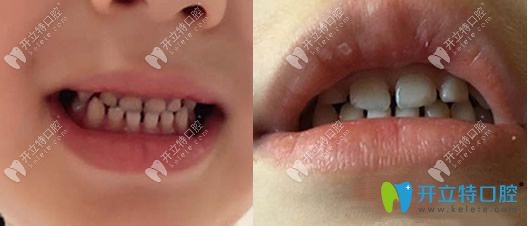孩子牙齒地包天戴MRC矯正器前后照片