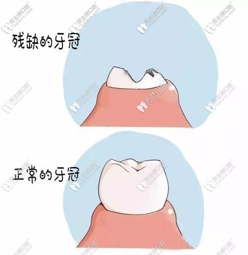 残根残冠拔除