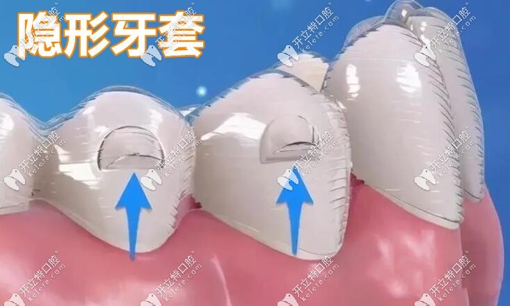 隐形牙套价格贵点