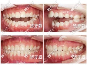 矯正病例前后對(duì)比